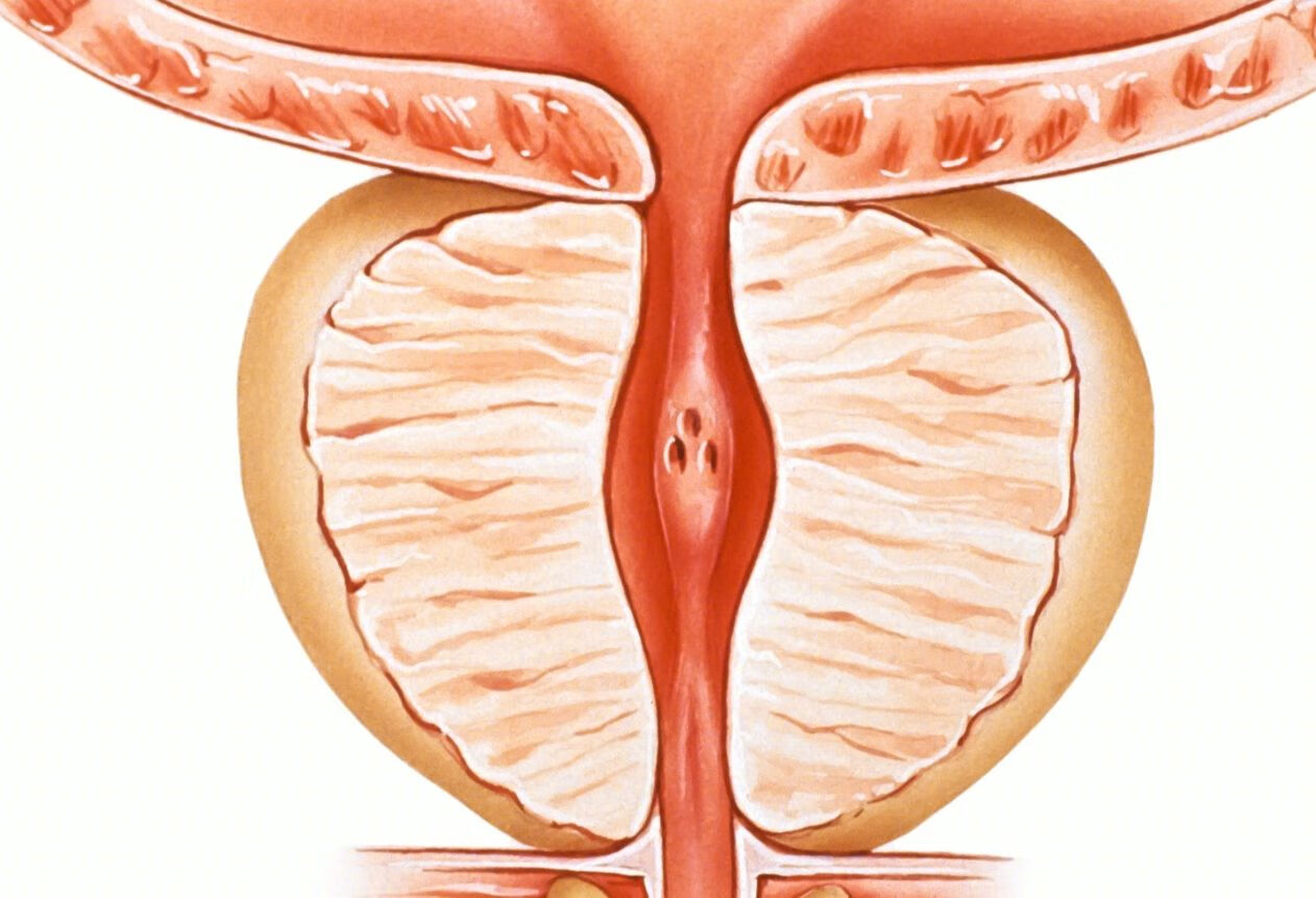 有没有办法彻底治疗前列腺炎？
