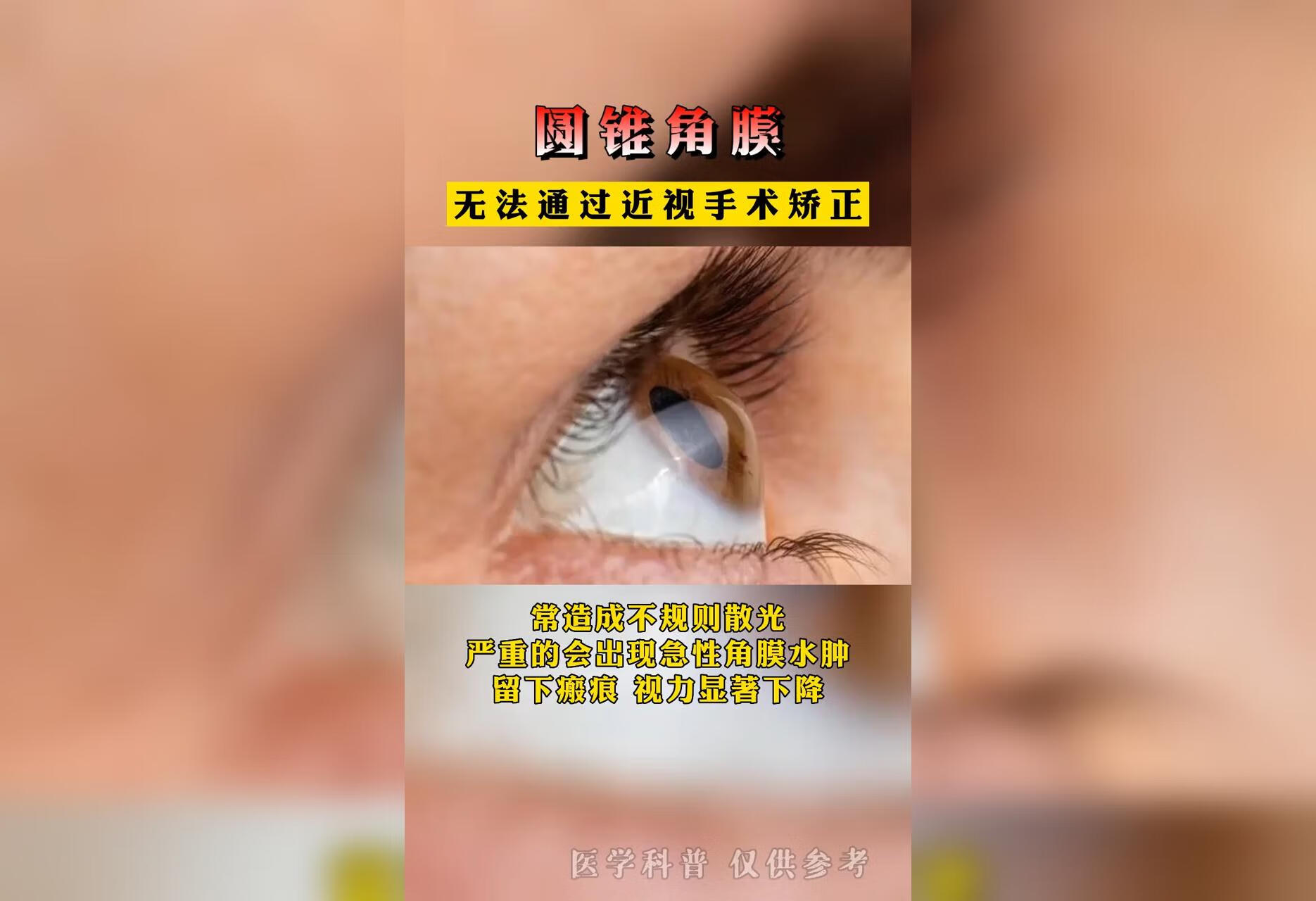 圆锥角膜无法通过近视手术矫正