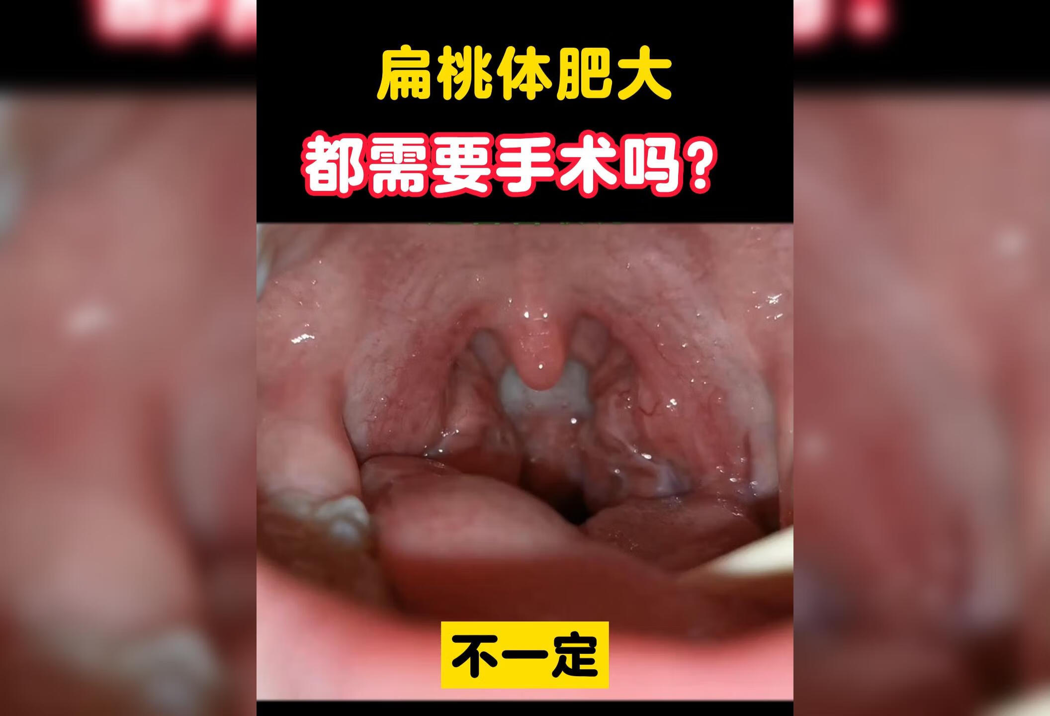 扁桃体肥大都需要手术吗？ 