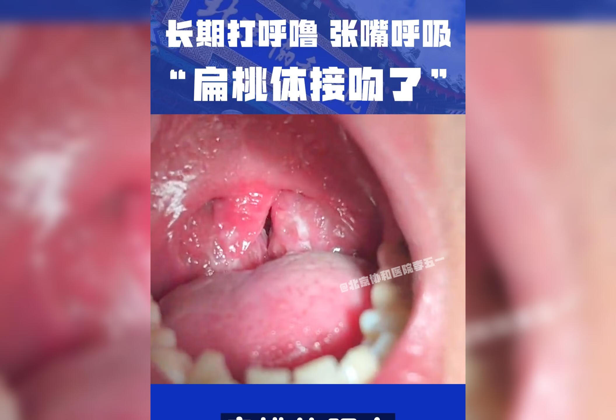 扁桃体肥大可能导致打呼噜