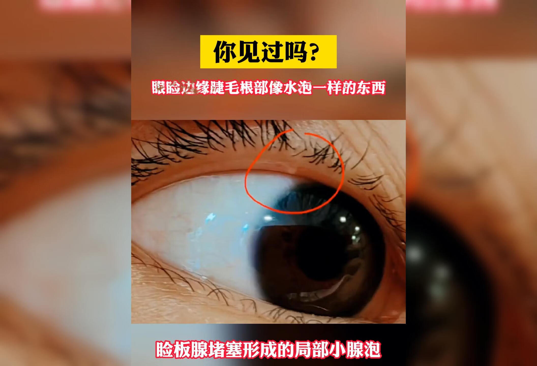 你见过眼睑边缘睫毛根部像水泡一样的东西吗？