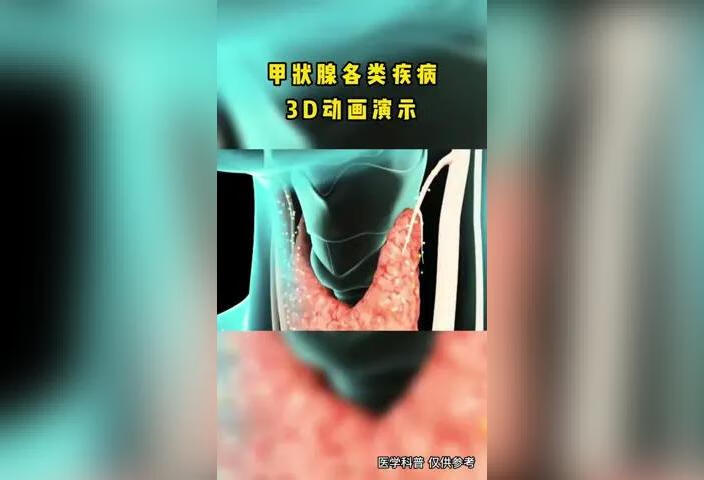 甲状腺各类疾病是什么样的？