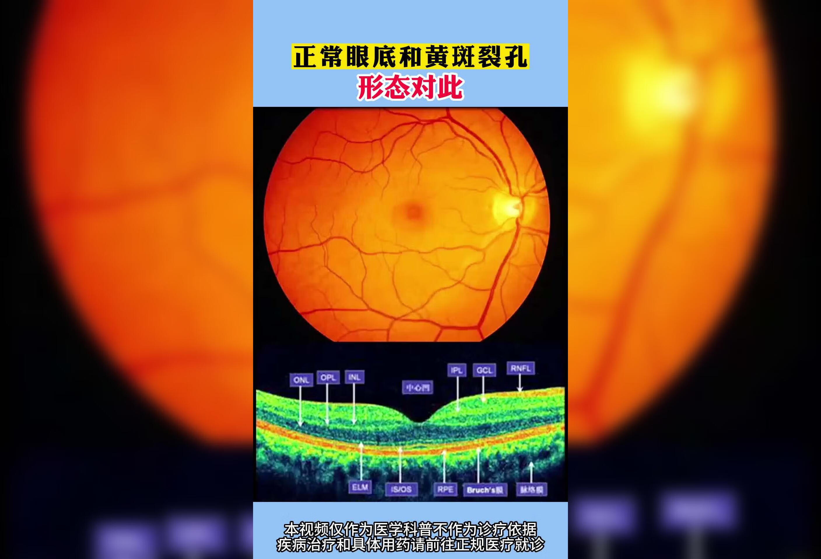 正常眼底和黄斑裂孔形态对比
