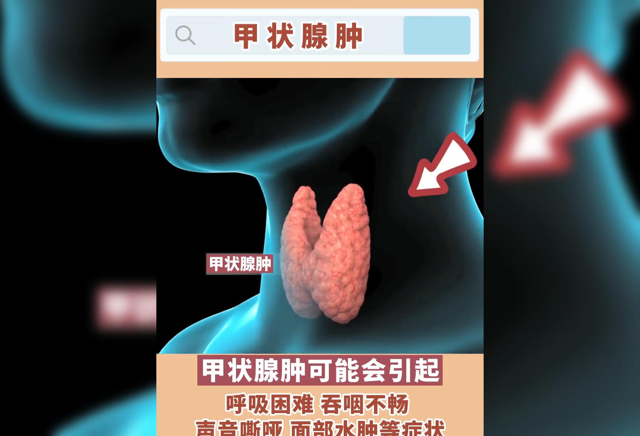 甲状腺囊肿定要及时就医检查