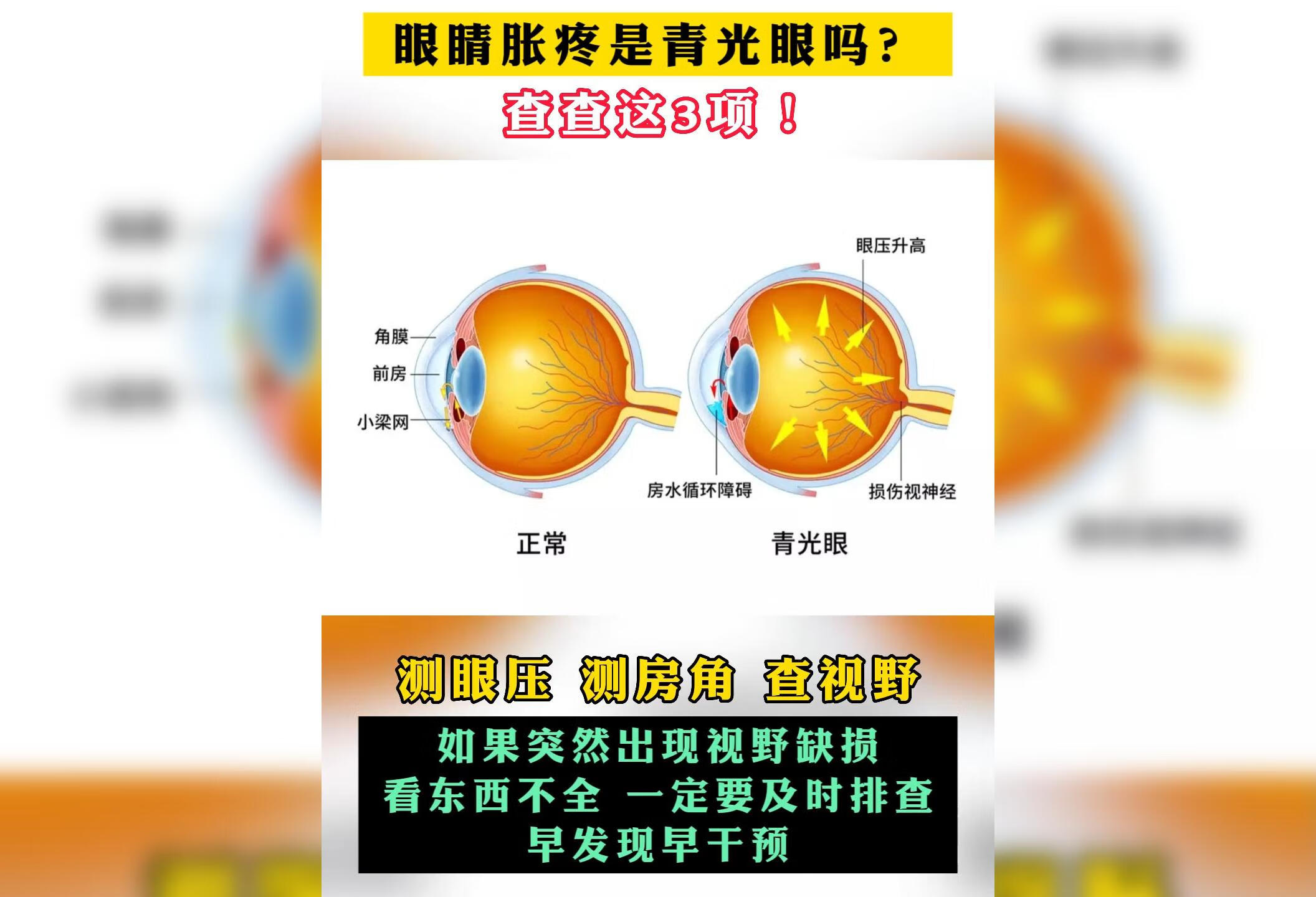 眼睛胀疼是青光眼吗？ 