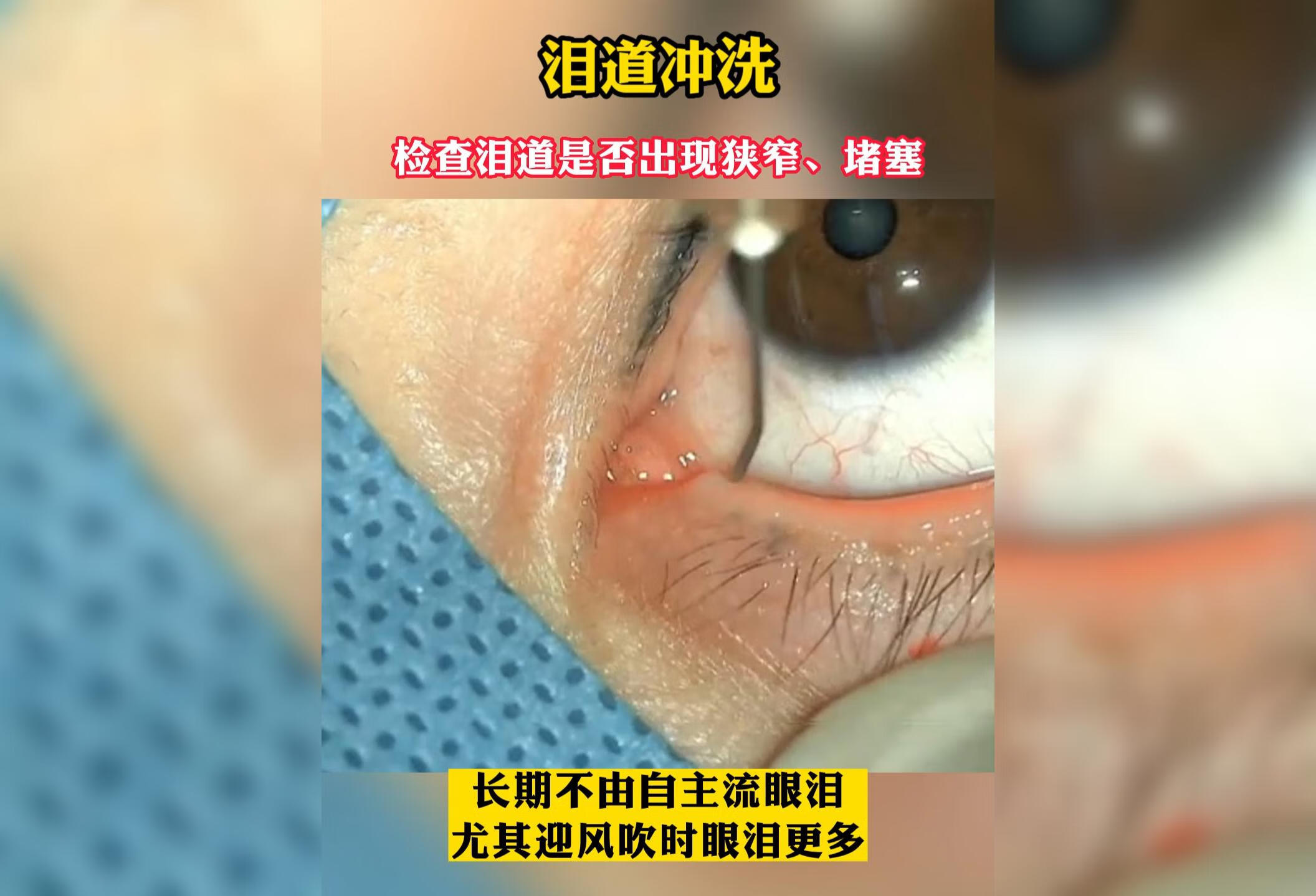 长期迎风流泪？可能是泪道堵塞眼睛