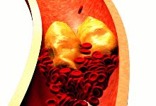 动脉硬化了，有什么办法能改善吗？
