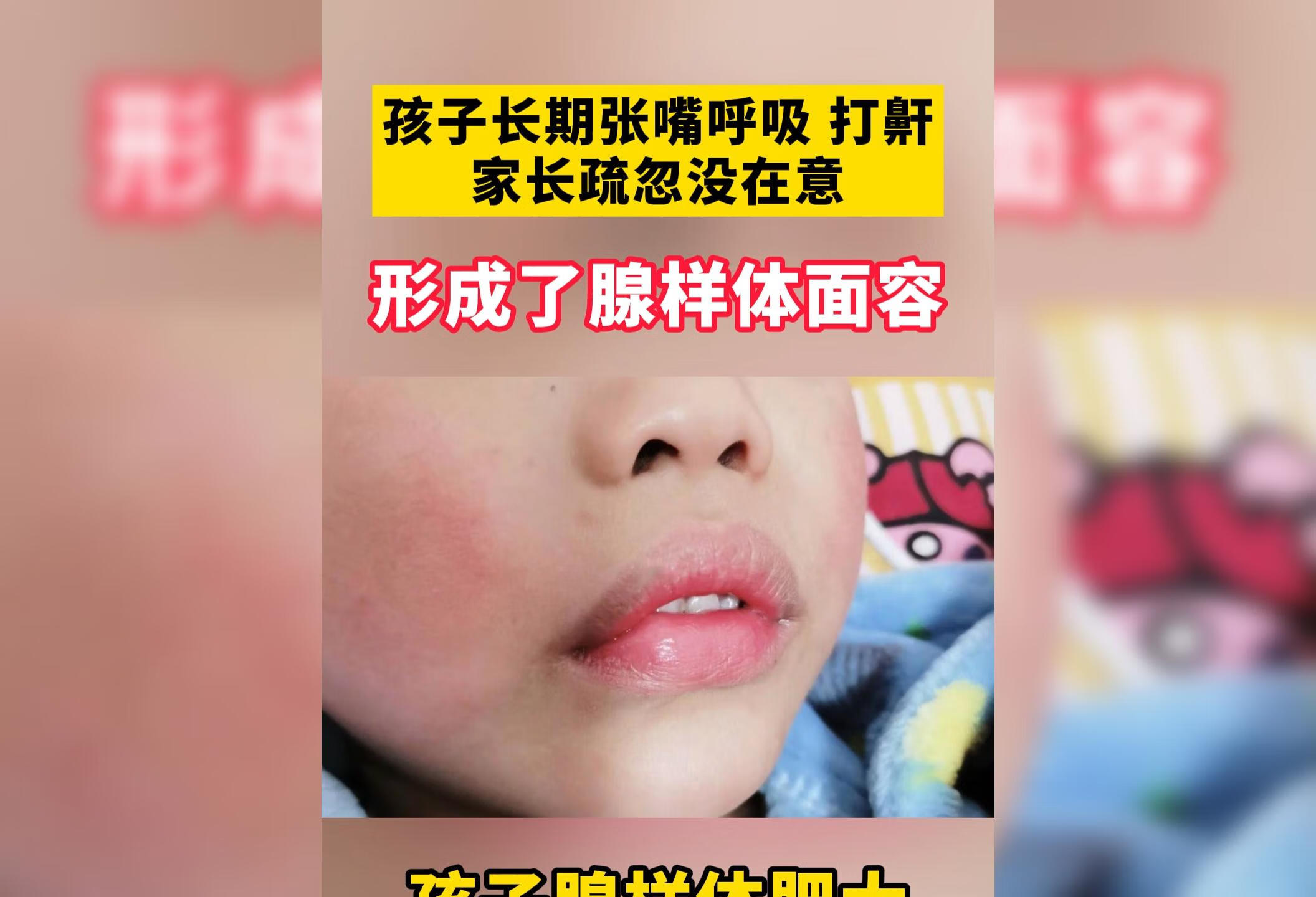 孩子长期张嘴呼吸会形成腺样体面容