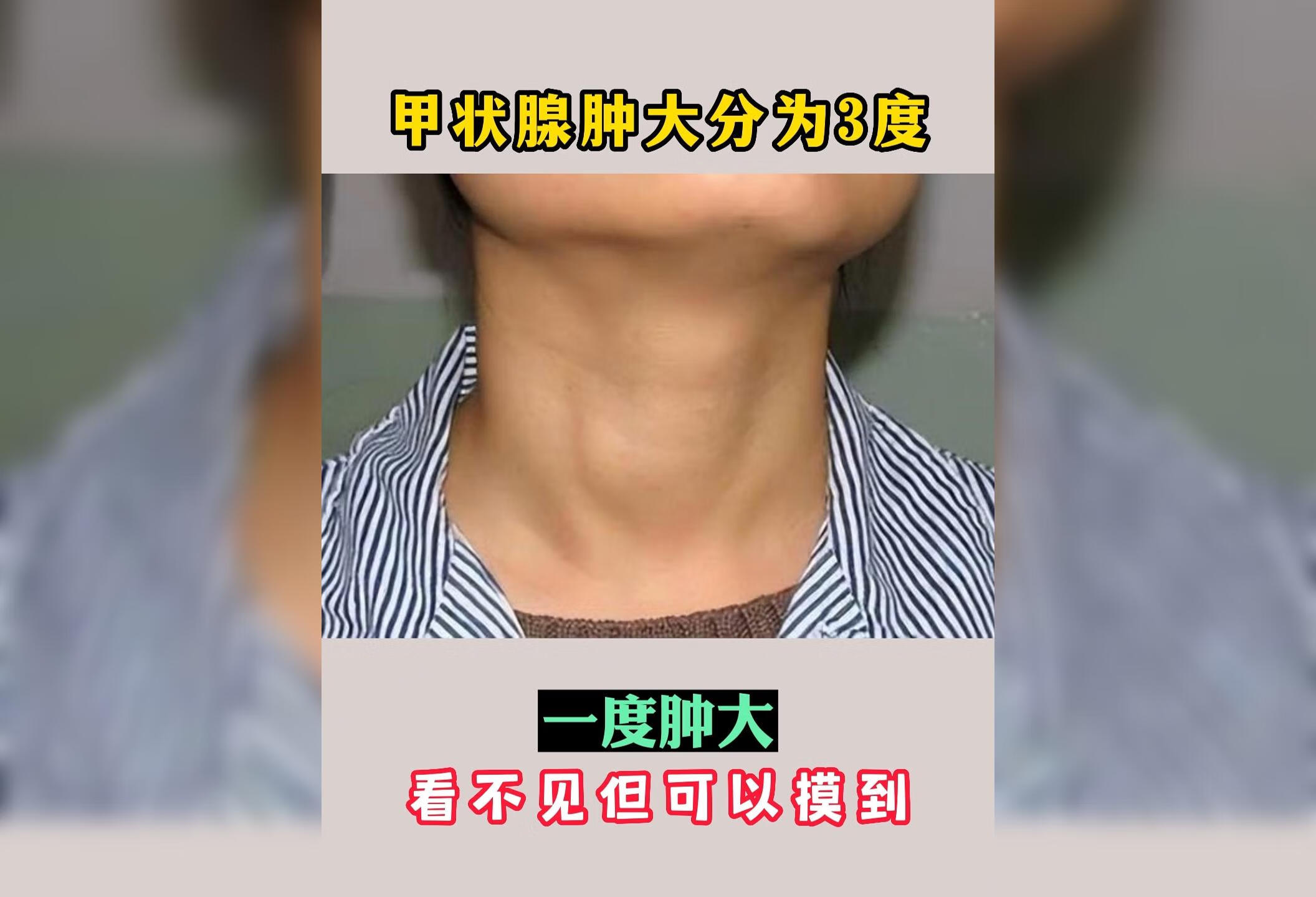 甲状腺肿大分为3度