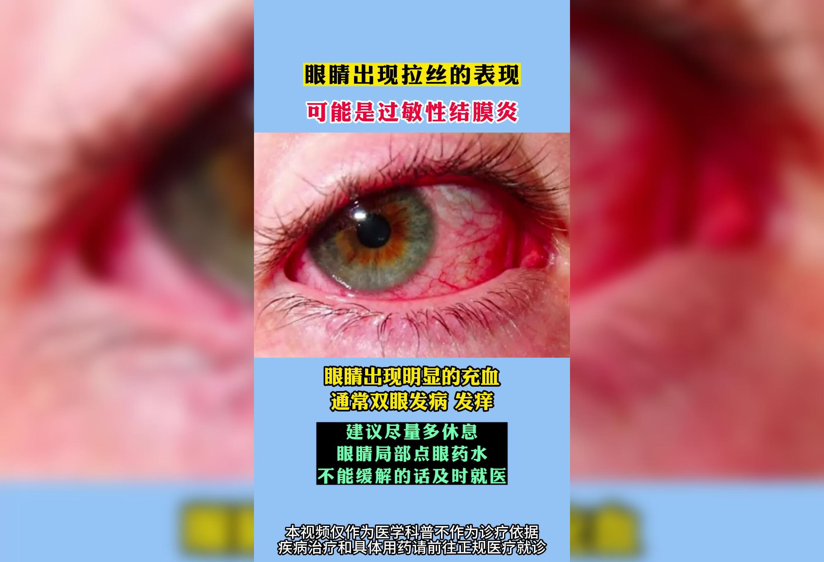 眼睛出现拉丝的表现得了什么疾病？