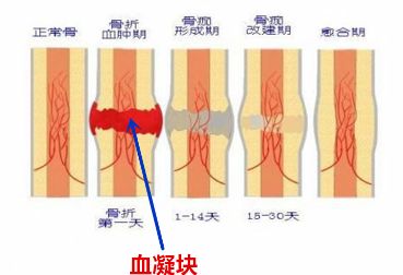 报告单上写着：断端对位满意，就一定好吗？