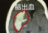 中风是脑出血吗？