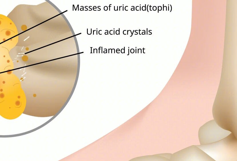 为何高尿酸患者，在病情有改善的情况下，痛风越发频繁