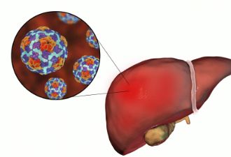 肝炎的患者应该怎么吃呢？