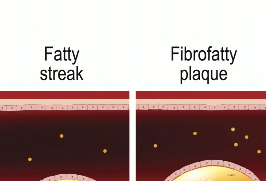 粥样斑块到冠心病，再到急性心肌梗死，需要注意什么？