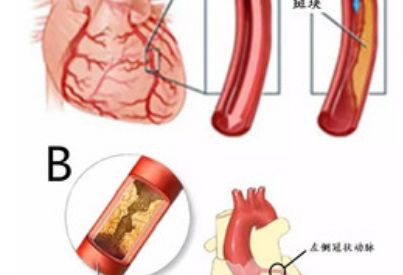 冠脉狭窄30-40%应该怎么办？听听心内科医生怎么说