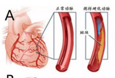 一住院做了心电图，还做心脏彩超？有时候还要造影?