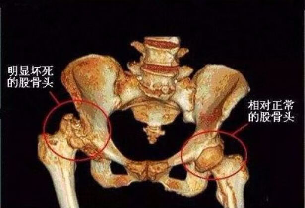 股骨头坏死临床症状和治疗方法