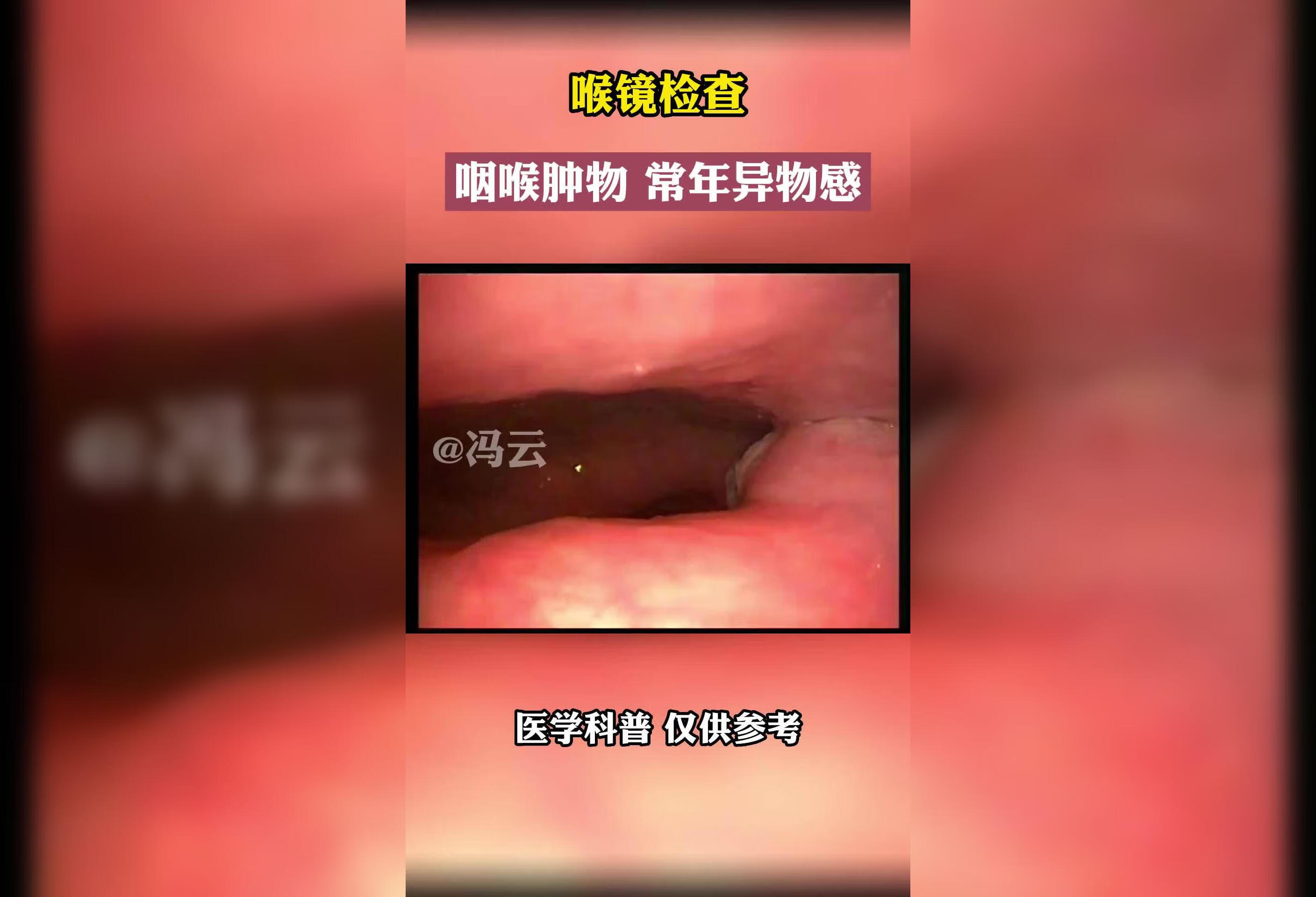 喉镜检查：咽喉肿物