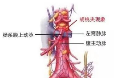 胡桃夹综合征是什么？竟会引起蛋白尿？