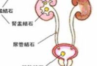 怎样判断自己得了尿路结石？