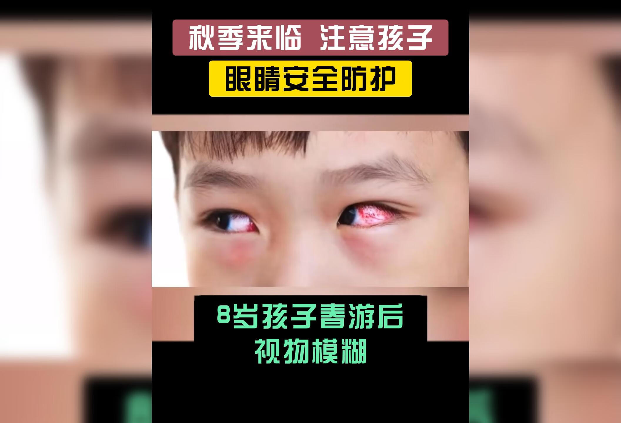 “红眼睛”其实是细菌性结膜炎