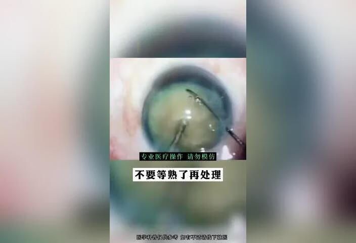 视力下降就可以做白内障，不用等成熟再去做