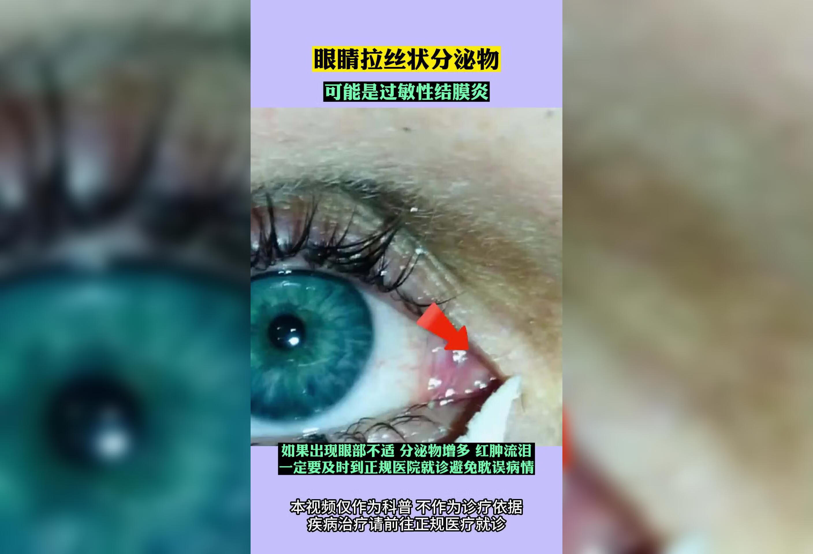 眼睛拉丝状分泌物可能是过敏性结膜炎