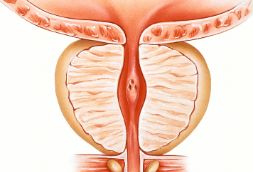 前列腺增生一定要早预防