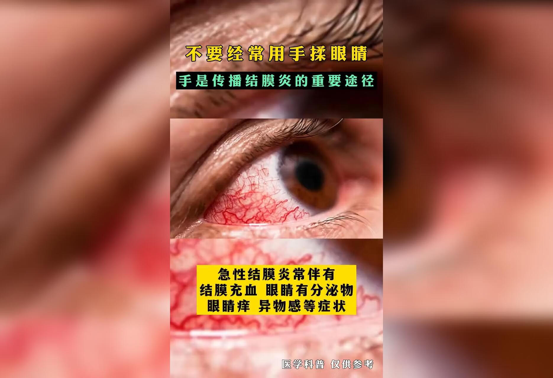 手揉眼睛传播结膜炎