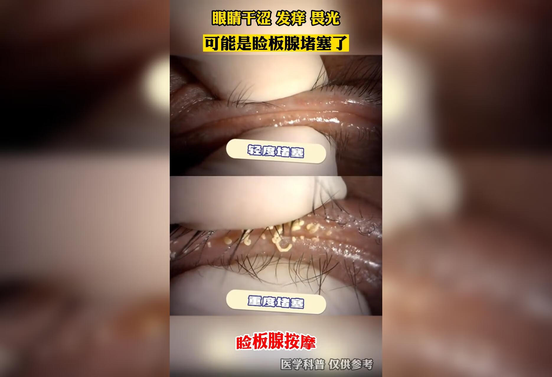 睑板腺按摩怎么做的