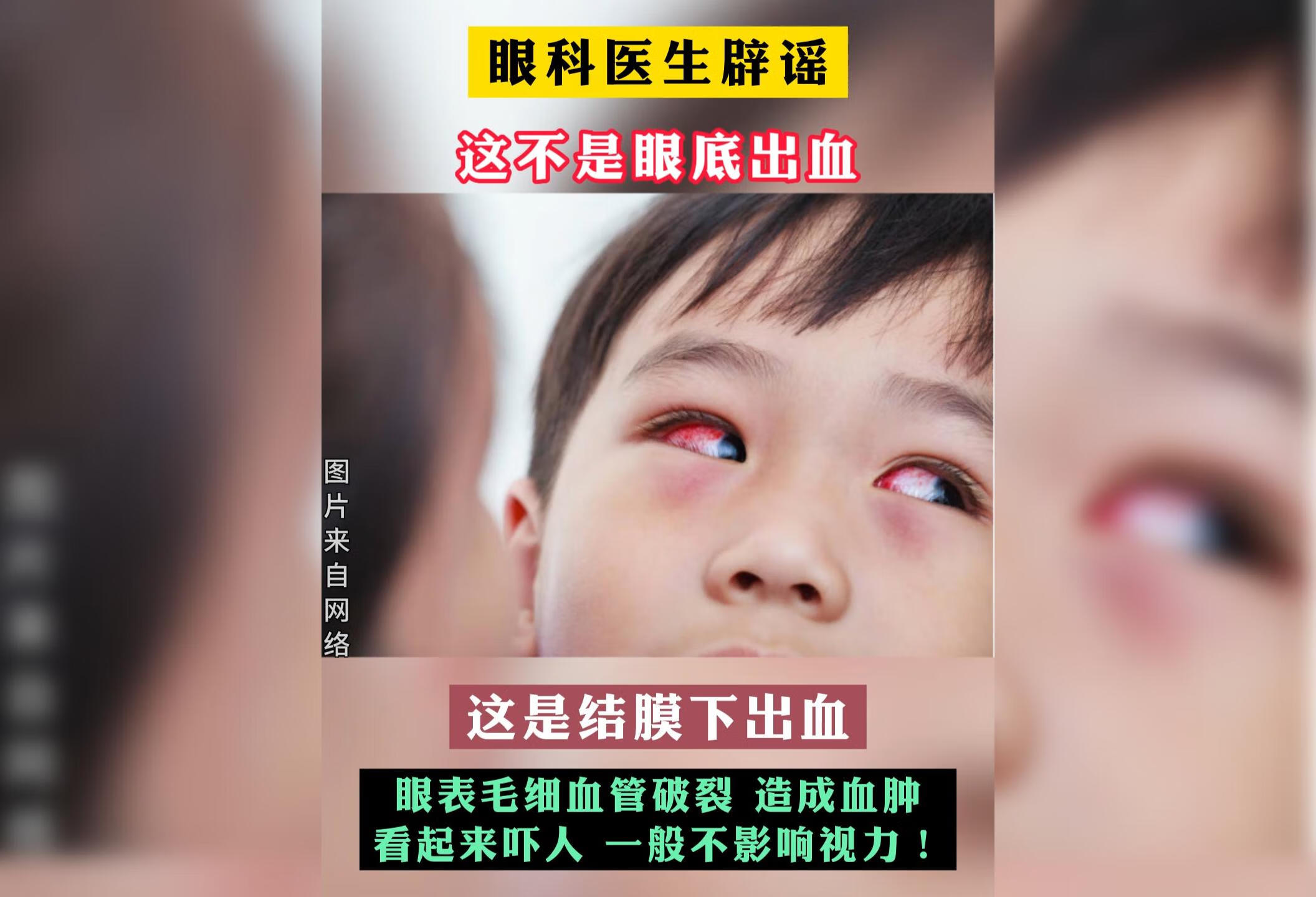 结膜下出血和眼底出血