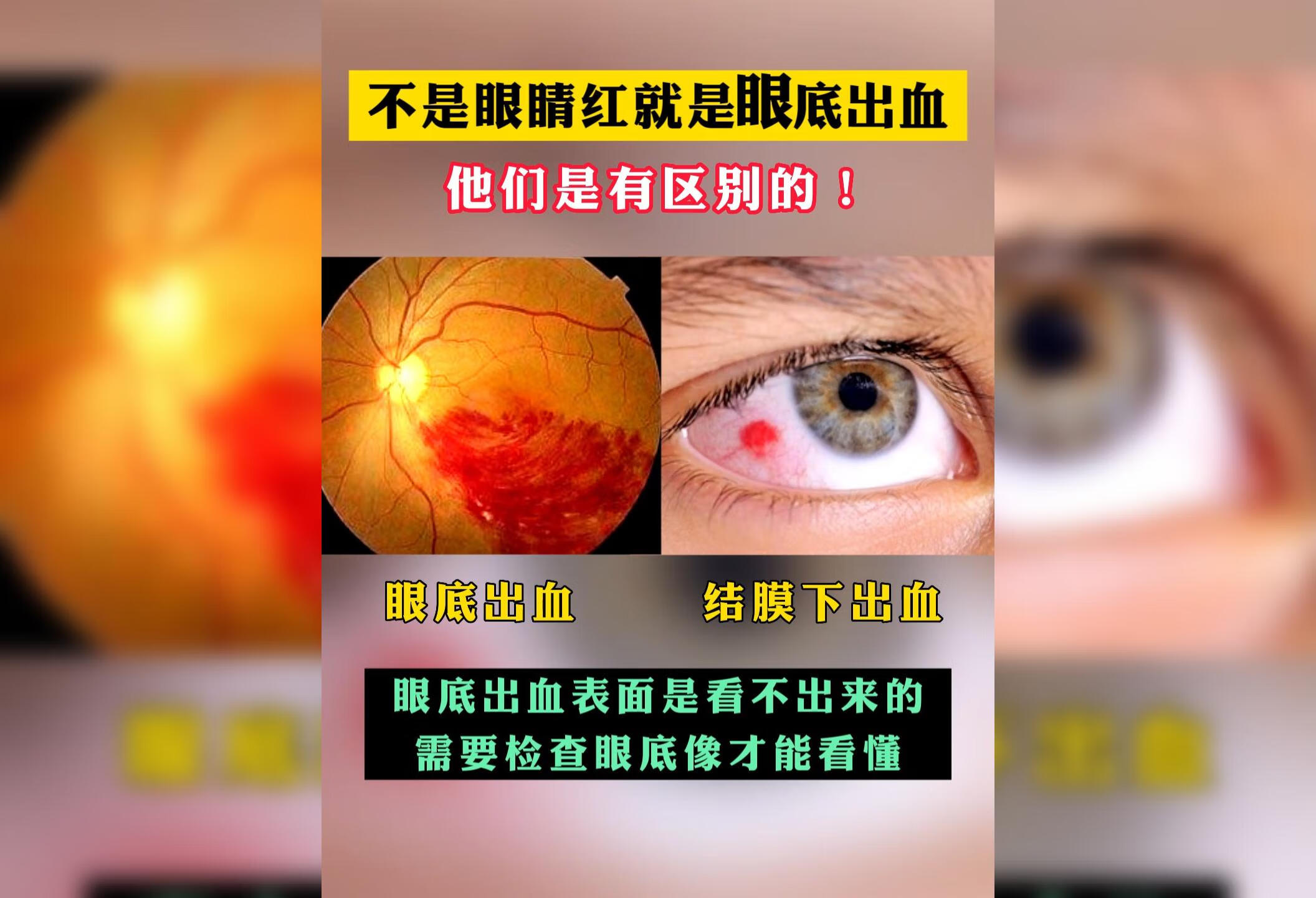 不是眼睛红就是眼底出血 