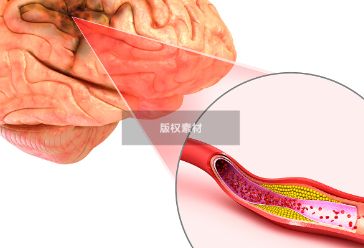 身体这4种表现，可能是脑血管