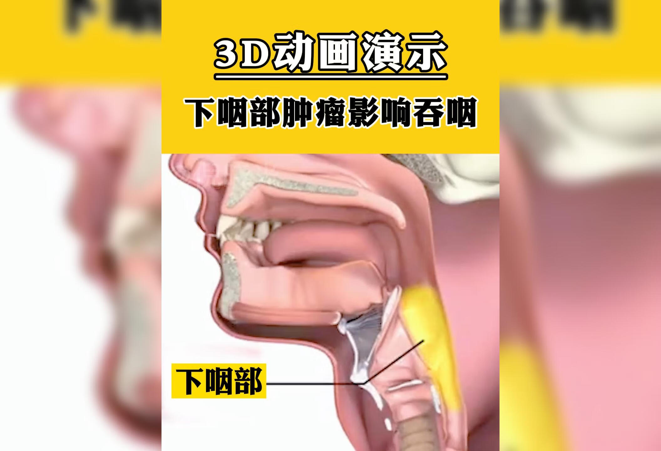 3D动画演示下咽部肿瘤影响吞咽