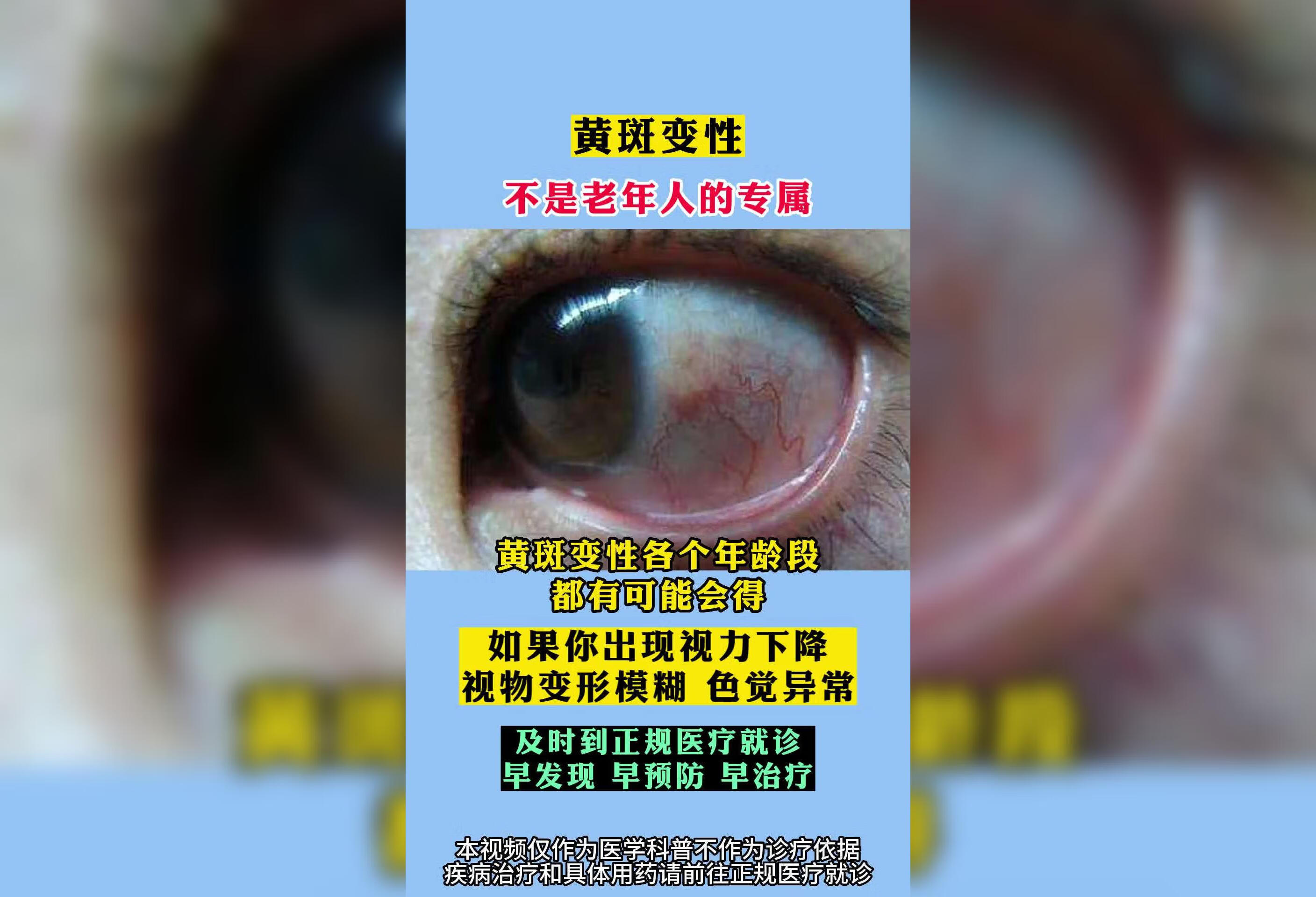 黄斑变性可以发生在各个年龄段