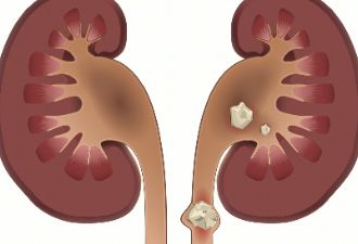 得了肾结石吃点溶石药就好了？医生：这种结石要手术