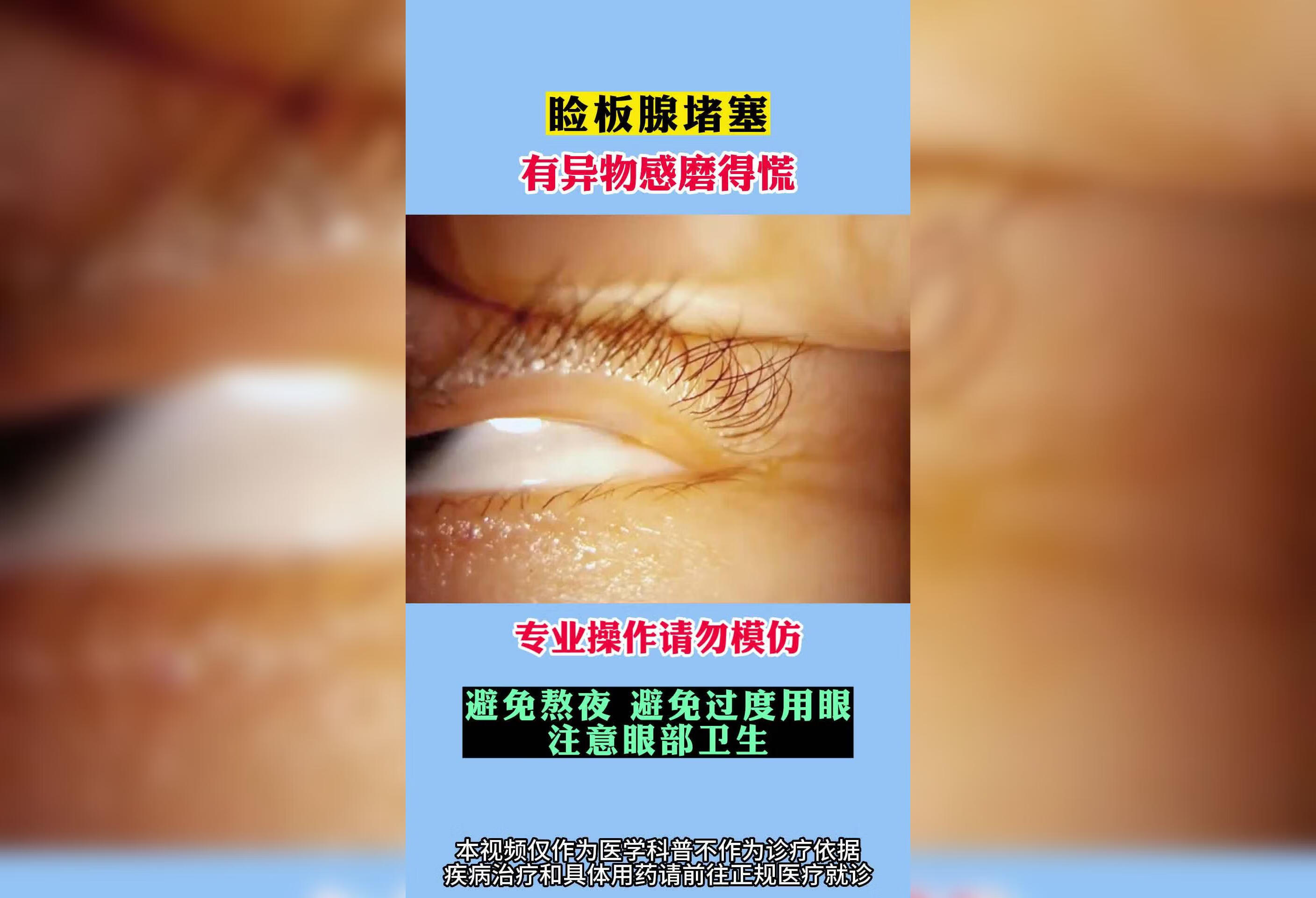 睑板腺堵塞，有异物感怎么办？