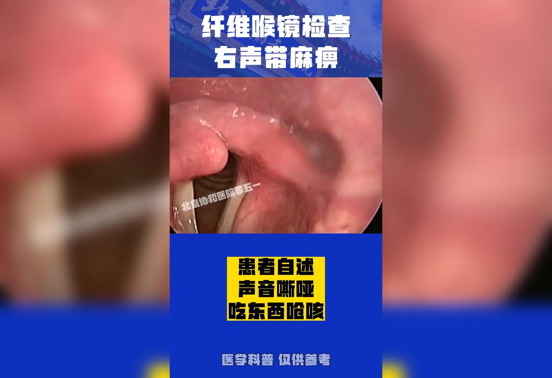 患者声音嘶哑，做喉镜发现声带麻痹