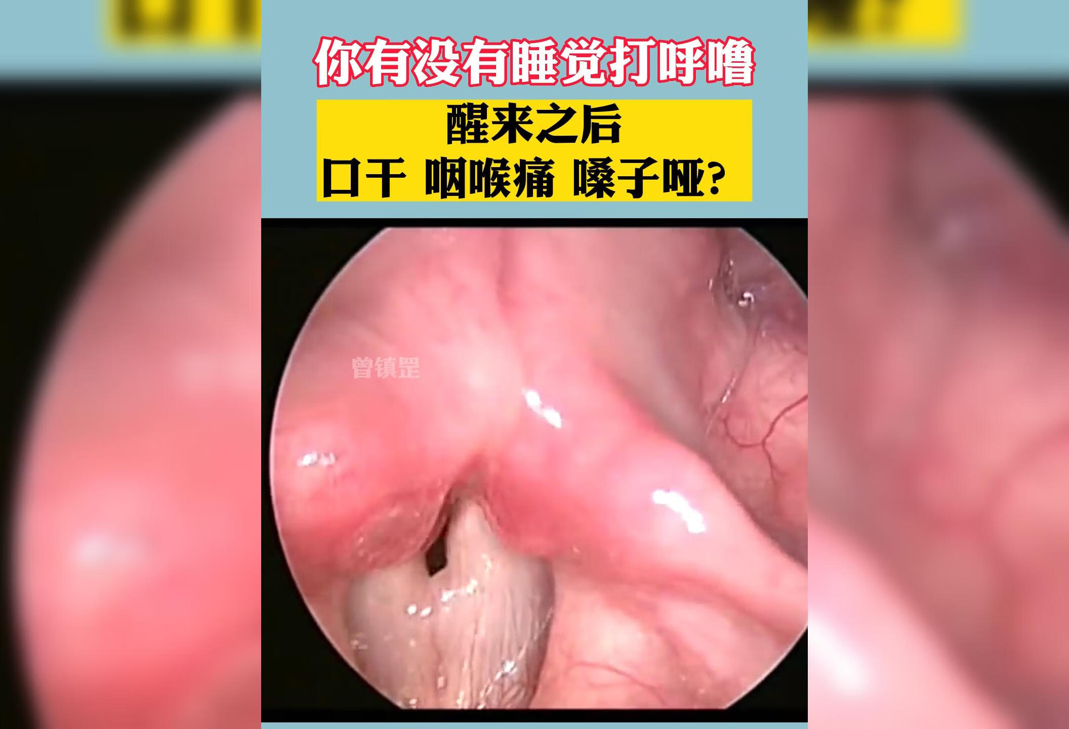 长期打呼噜声带小结 