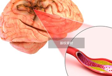 脑血管为什么会发生梗死呢？