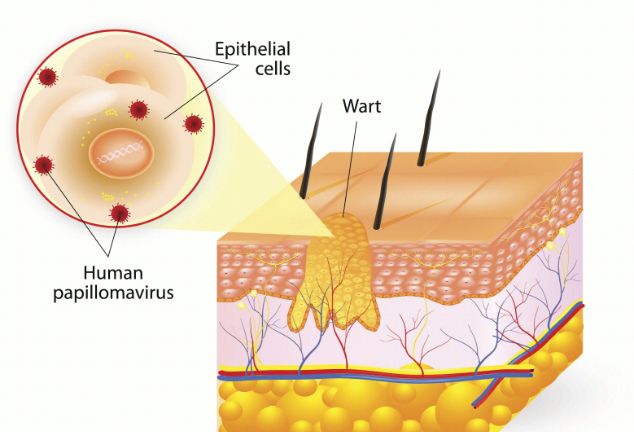 尖锐湿疣是怎么引起的？