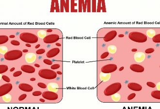 严重贫血可危及生命！别再把贫血不当回事