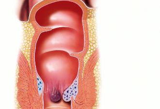 内痔、外痔、混合痔，得了痔疮怎么办？如何预防？