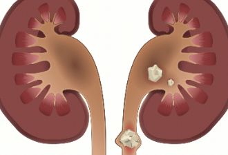 体外冲击波碎石术后肌酐升高，中药合理治疗后，肌酐戏剧性下降了