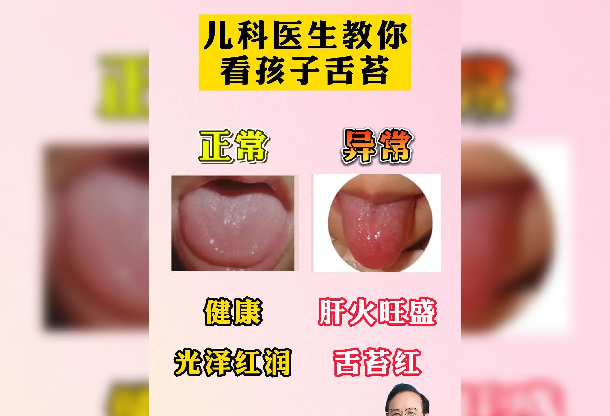 看看您家孩子是什么样的舌苔呢？