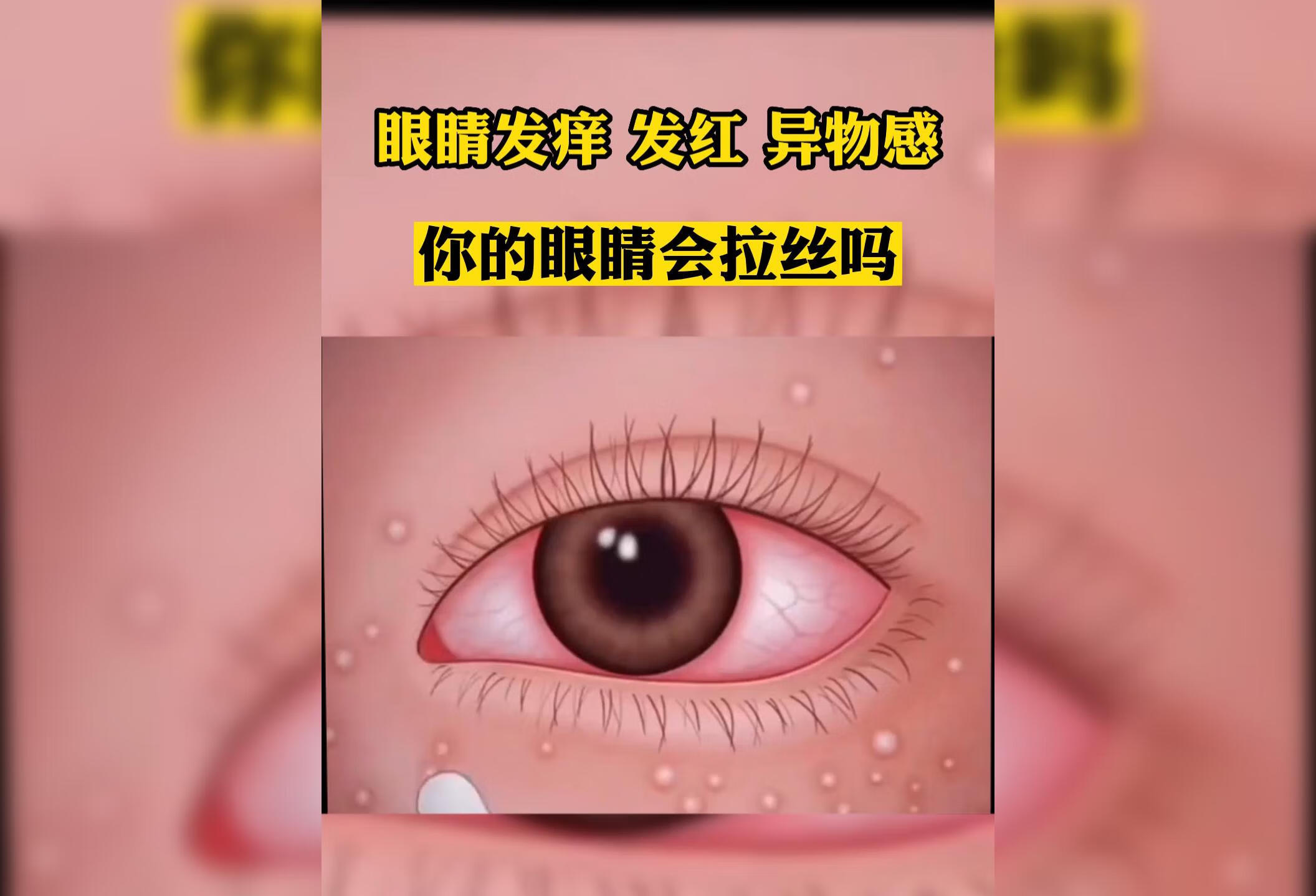 眼睛出现会拉丝的分泌物，及时治疗 