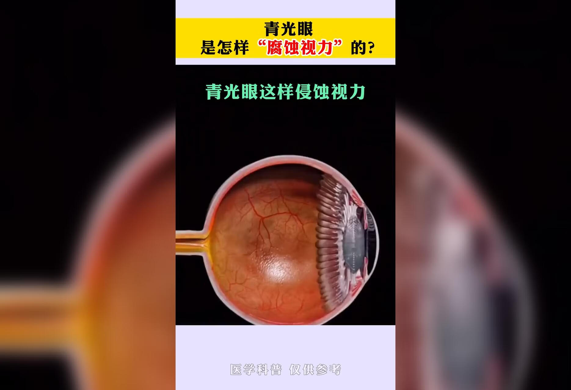 青光眼 是怎样腐蚀视力的？