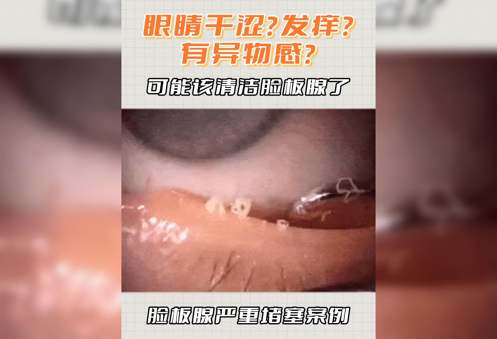 眼睛干涩？发痒？有异物感？可能该清洁睑板腺了