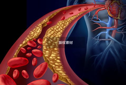 日常养护血管，坚持做好这3件事，脑血管疾病不来扰